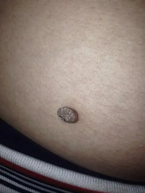 在肚子上的猴子现在变成这样了,有事吗