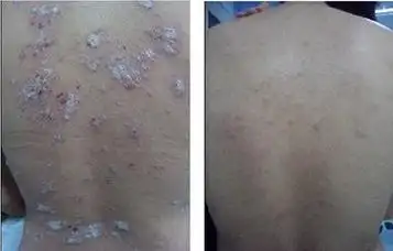 牛皮癣的并发症有哪些_肤康皮肤专科医院