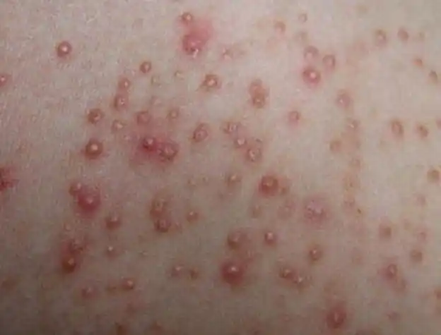 阴茎长毛囊炎的症状图片