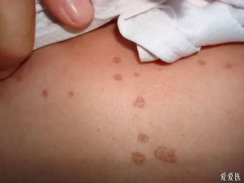 典型皮肤病之汗孔角化症