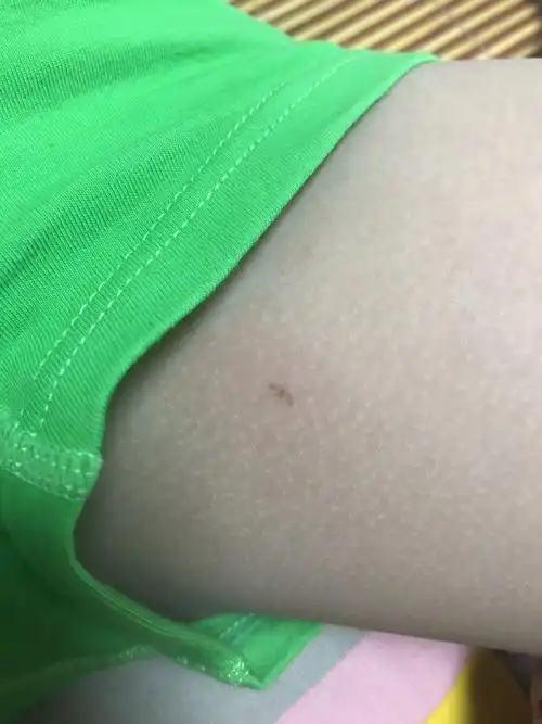 会不会越长越大,孩子6岁,有点像扁平疣的感觉,应该不是.