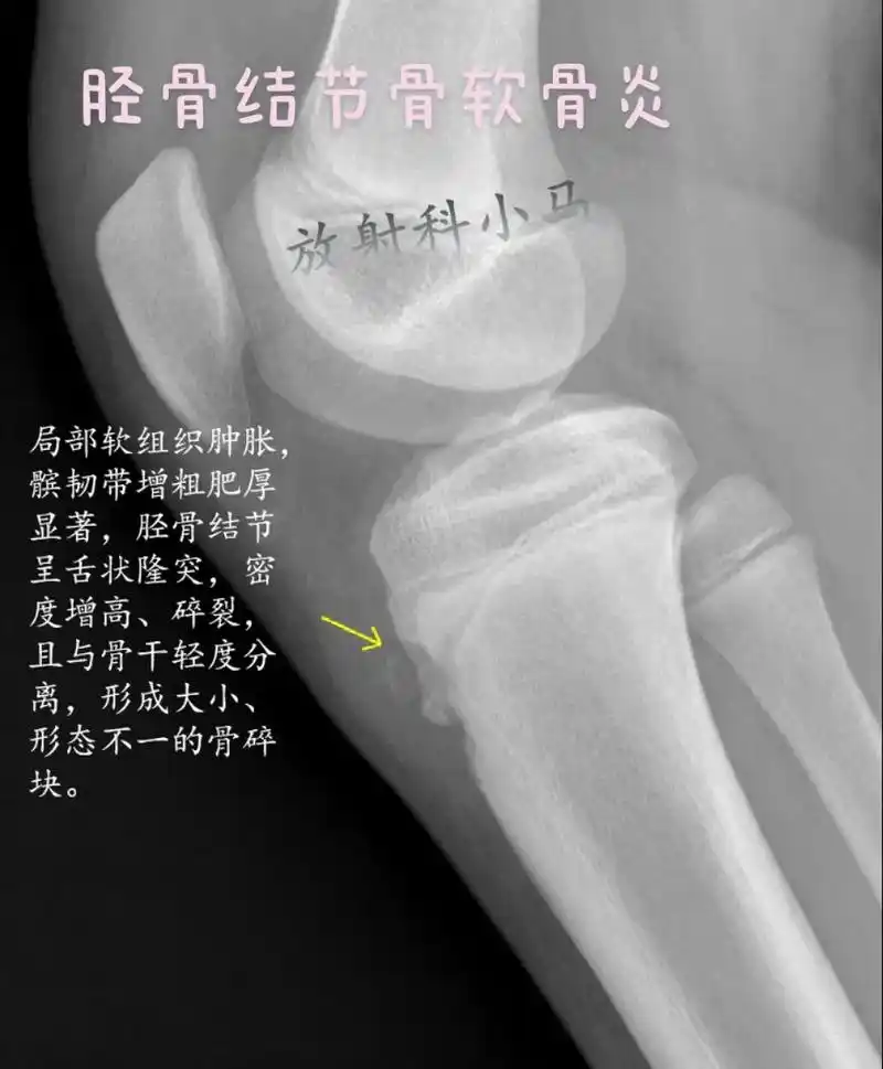 胫骨结节骨软骨炎.胫骨结节骨软骨炎(osgood-schla - 抖音