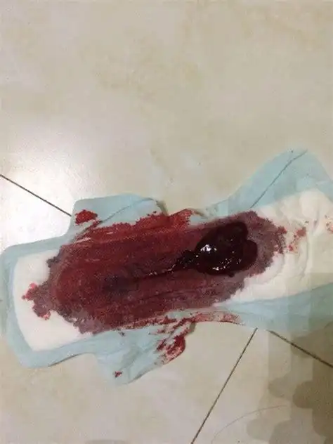 月经突然量大有血块月经突然量大有血块是怎么回事2022已更新今日资讯