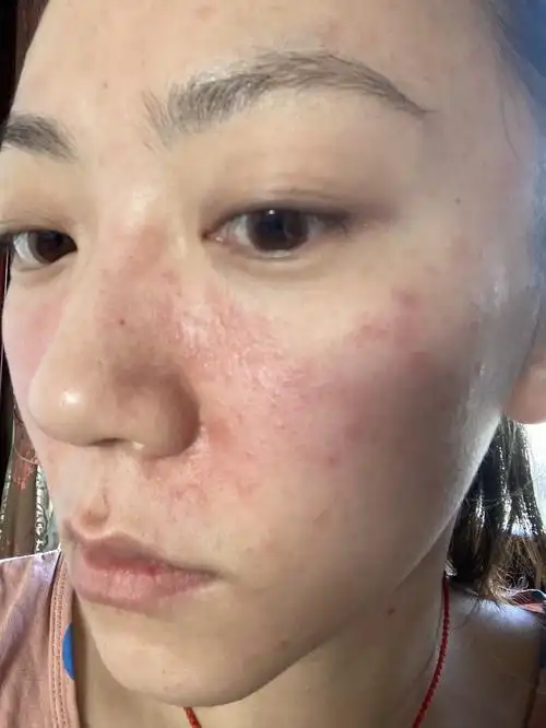 脸部过敏护理小贴士