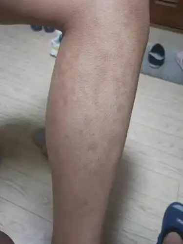 1/5这个是全身严重牛皮癣患者,全身已恢复,只有腿上有点深色印子.