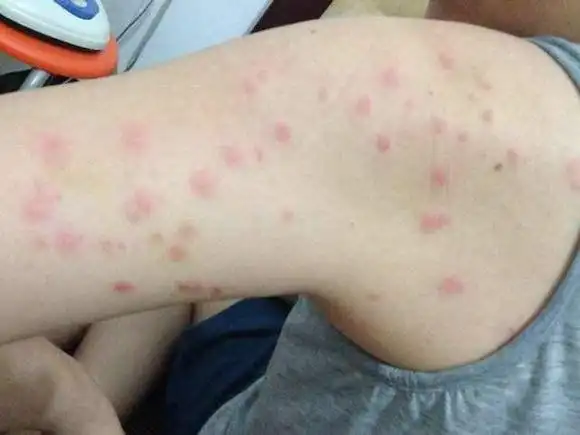 人体长时间与螨虫接触,会很大程度上患上皮肤病,而且还会引起过敏症状