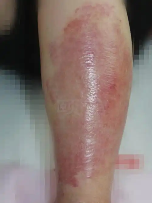 丹毒的治疗方法(风丹是怎么引起的) 丹毒的治疗方法 第2张