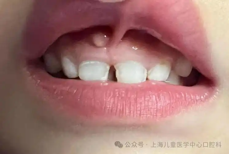 儿医小课堂 218 | 孩子牙龈上长了小包该怎么办?