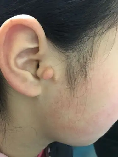 什么是附耳?_耳部整形_疾病介绍_治疗介绍 - 好大夫在线