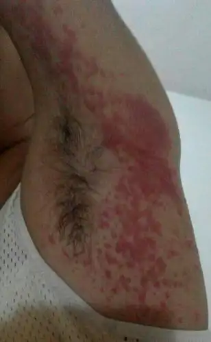 腋下长了一片红疙瘩,白天没事,一到晚上就痒,开始