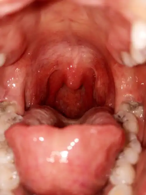 去喝水,咽水都很痛,一直有异物感,看了下镜子吓到了,小舌头肿起来了