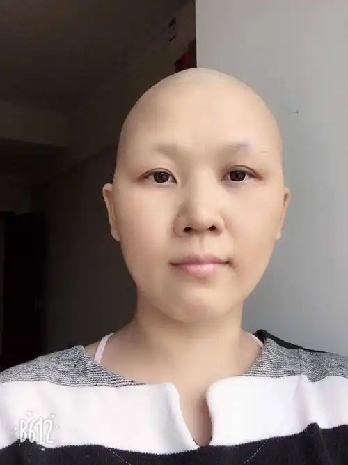 我也晒一下光头照 纪念一下自己这段路程的不容易