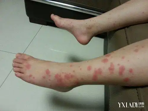 螨虫过敏症怎么防治? 6大防治手段介绍给你们