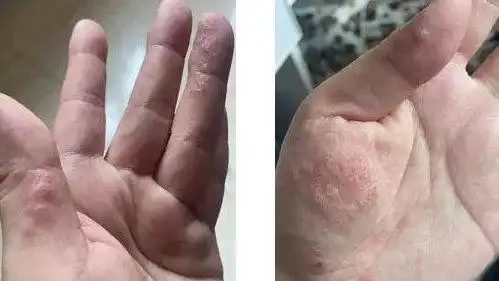 发布了头条文章:《手上长水疱?你可能被汗疱疹盯上了》