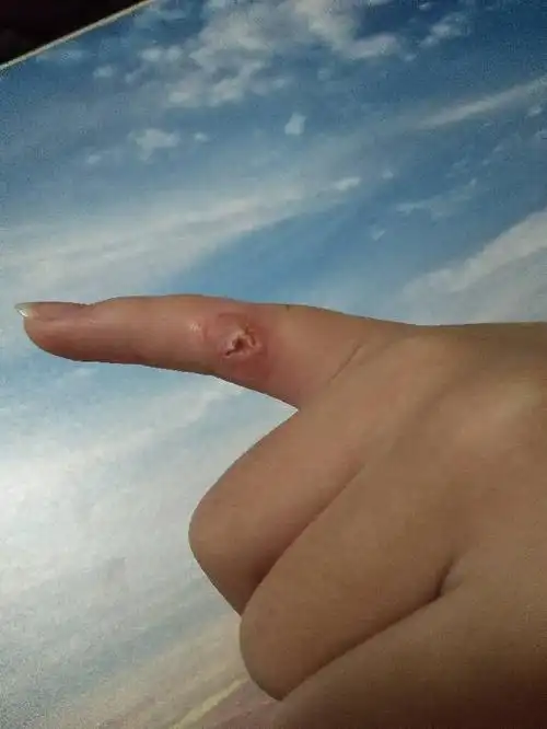 之前手上长了一个疣,挺小的,然后贴了4天鸡眼膏,现在这样了,怎么办