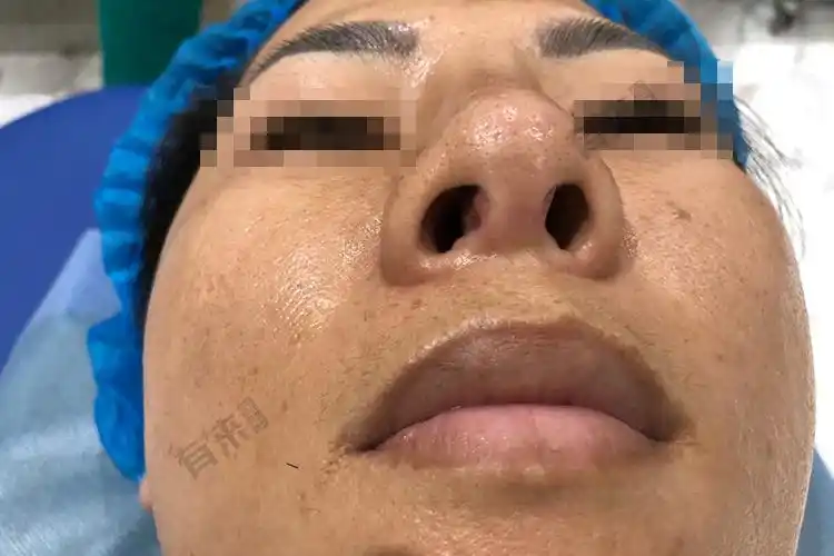 隆鼻后增生表面粗糙图