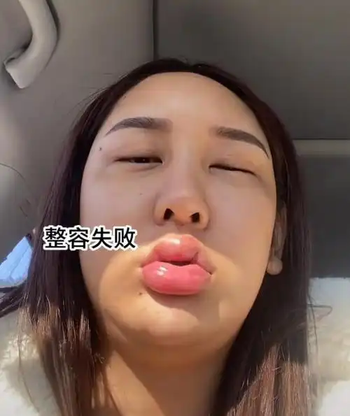 女网红晒整容失败视频,眼睛睁不开,嘴肿成"嘟嘟唇"