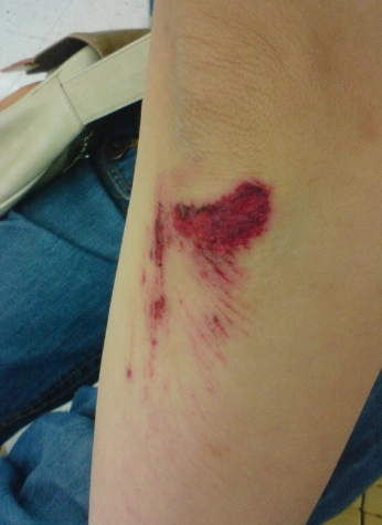 胳膊流血真实图片53