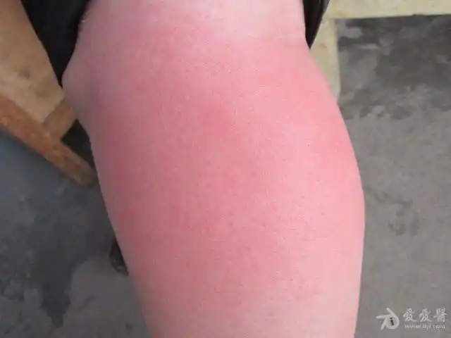 欢迎大家积极参与【爱爱医原创图片节】-全科医疗讨论版分站征稿