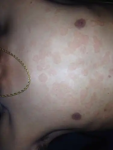 汗斑有3年了以前很少现在胸口和脖子上都有许多了