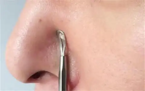 鼻子上挤出来的白色丝状物是什么如何去除改善建议做好3件事