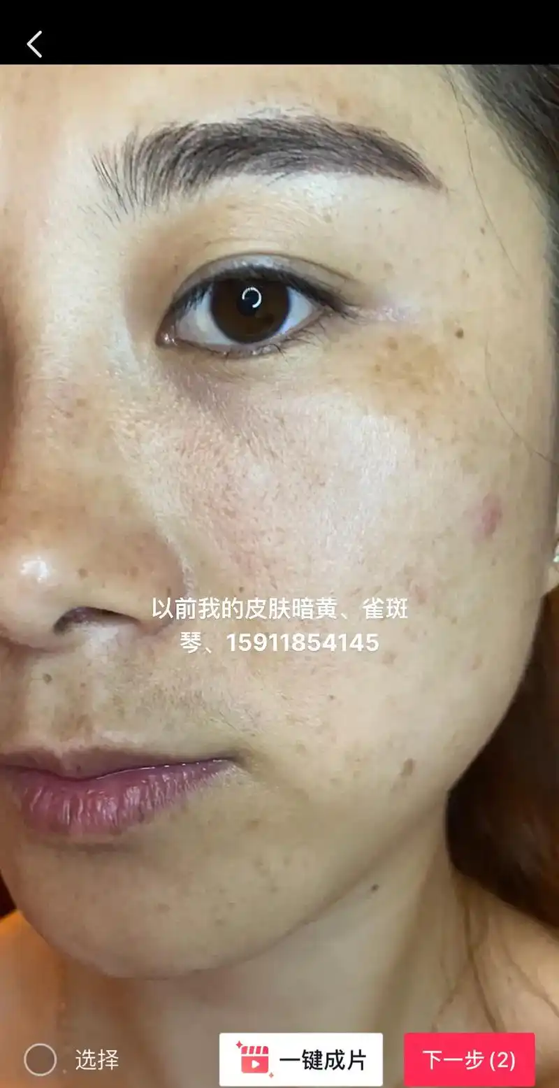 皮肤逆袭 青春只有一次,别给别人留下满脸雀斑的标签 - 抖音