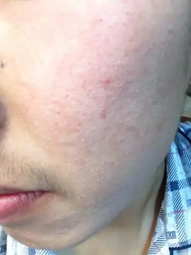 我是牛皮癣患者两年了,现在脸上不知道是不是牛皮癣,每天洗完脸之后