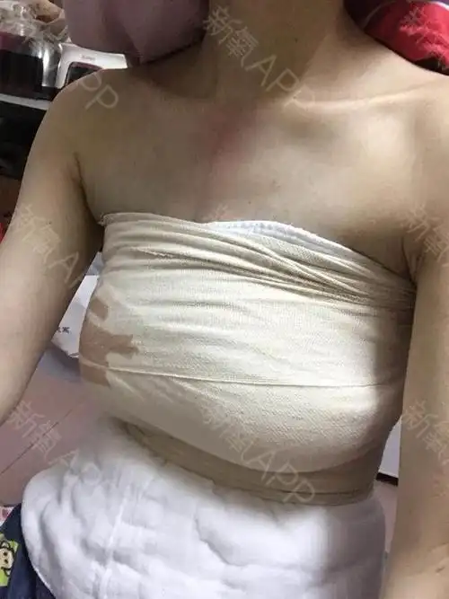 我虽然年龄不大但是自从生完宝宝哺乳过就胸部下垂很严_圈子-新氧美容