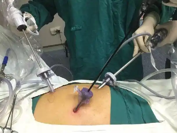 科学预防治疗胆囊结石