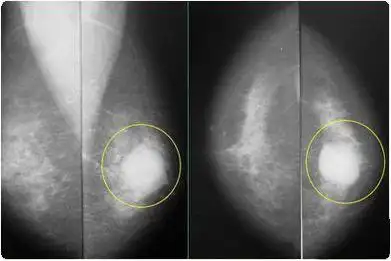 乳腺纤维腺瘤是一种良性肿瘤,高发于青年女性.