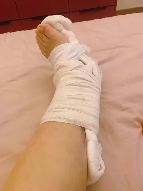 踝骨骨折术后21天