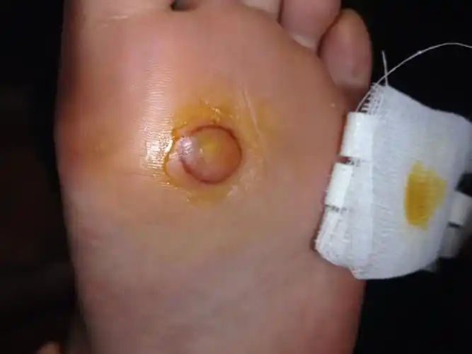 液氮冷冻后,被冻伤,起了水泡.