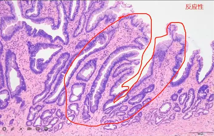 gastric dysplasia consists ofunequivocalneoplastic changesof the