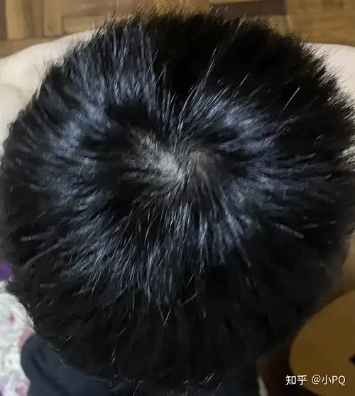 我这头顶漩涡处头发量正常吗? - 知乎