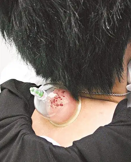 他脖子后方拔罐放血,血珠愈来愈大颗