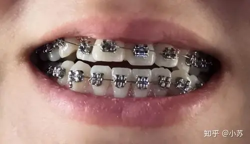 成年地包天戴牙套矫正