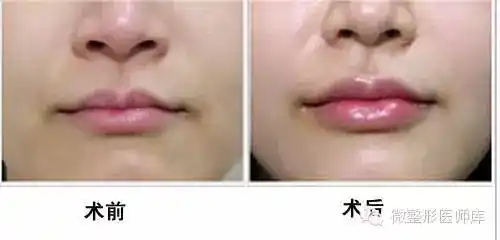 没有唇珠怎么都不叫完美