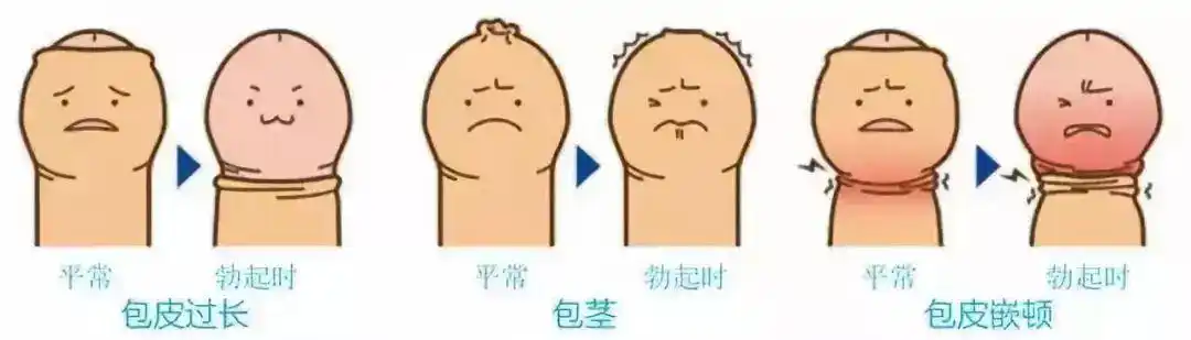 一文搞懂包皮多长算过长过长一定要割吗不割行不行