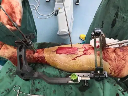 胫腓骨双段骨折闭合复位髓内钉内固定