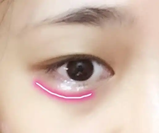 下眼皮红肿了,不是眼袋部分是下眼皮.