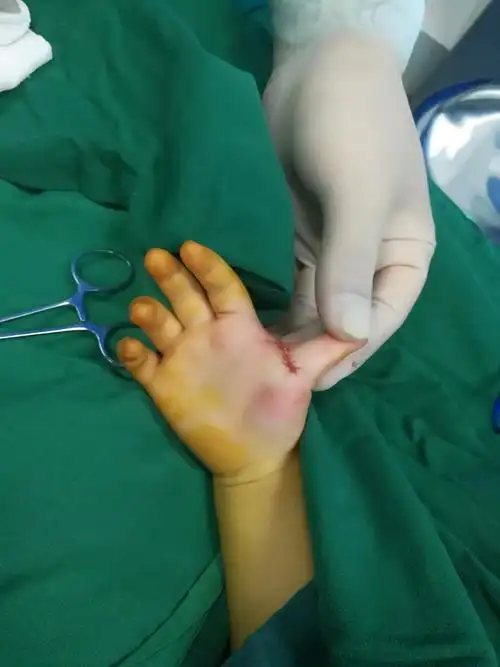 小儿扳机指的治疗