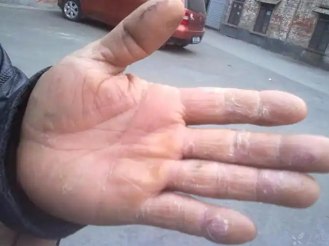【病例讨论】快来看看这只手是不是真菌感染了