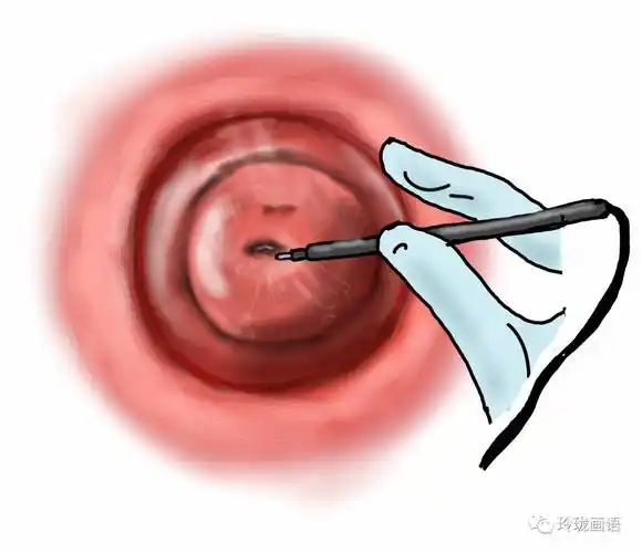 宫颈肥大,糜烂,囊肿,您还在花冤枉钱吗?