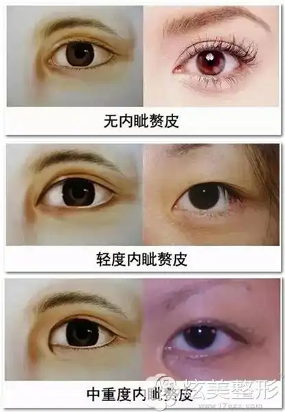 内眦赘皮的不同程度