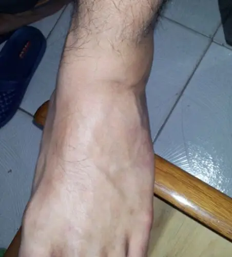 上年9月打球扭到了左脚,到现在还很肿,怎么办