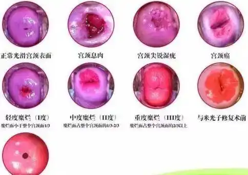 女性可怕的宫颈病变炎症糜烂囊肿息肉肥大防大于治呀60