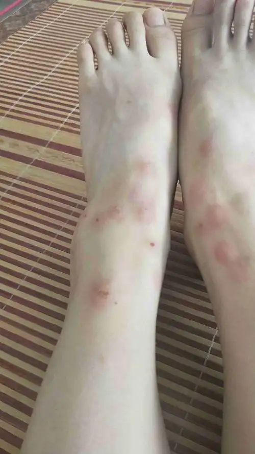 我想问一下我这个是跳蚤咬的吗,要怎么消掉(很痒)