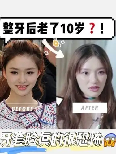 整牙后老了10岁牙套脸真的很恐怖