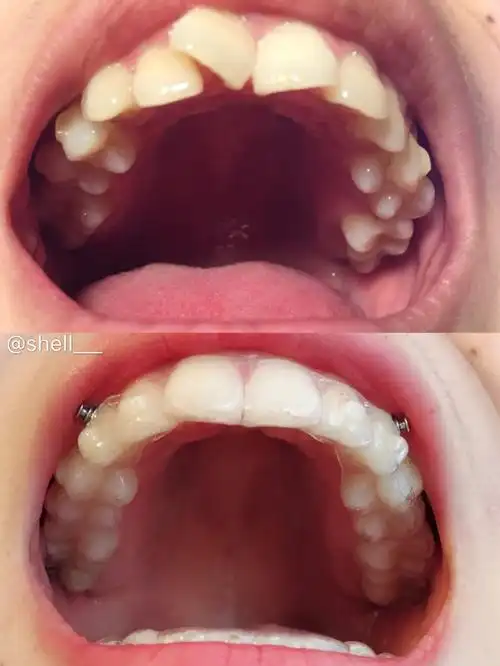 结束才发 是因为最近我翻到以前的照片 才发现一口整齐牙齿是多么的