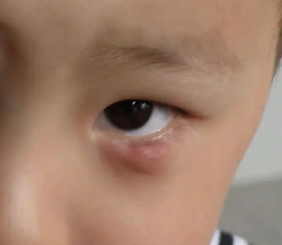 孩子下眼皮长一疙瘩40几天